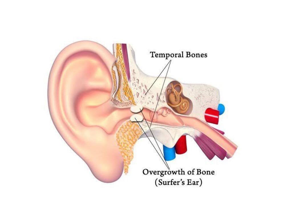 Protect Your Ears: Preventing Surfer's Ear